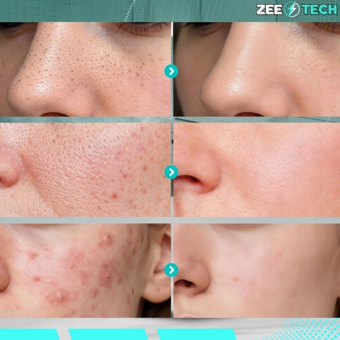 Urządzenie do peelingu kawitacyjnego 3w1 – oczyszczanie twarzy ultradźwiękowe, jonoforeza i sonoforeza, lifting i regeneracja skóry